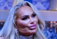 Darcey Silva’s SHOCKING Face After Removing Fillers From Her Face!