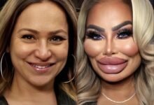 Darcey Silva’s SHOCKING Face After Removing Fillers From Her Face! Darcey Silva’s SHOCKING Face After Removing Fillers From Her Face!