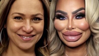 Darcey Silva’s SHOCKING Face After Removing Fillers From Her Face!